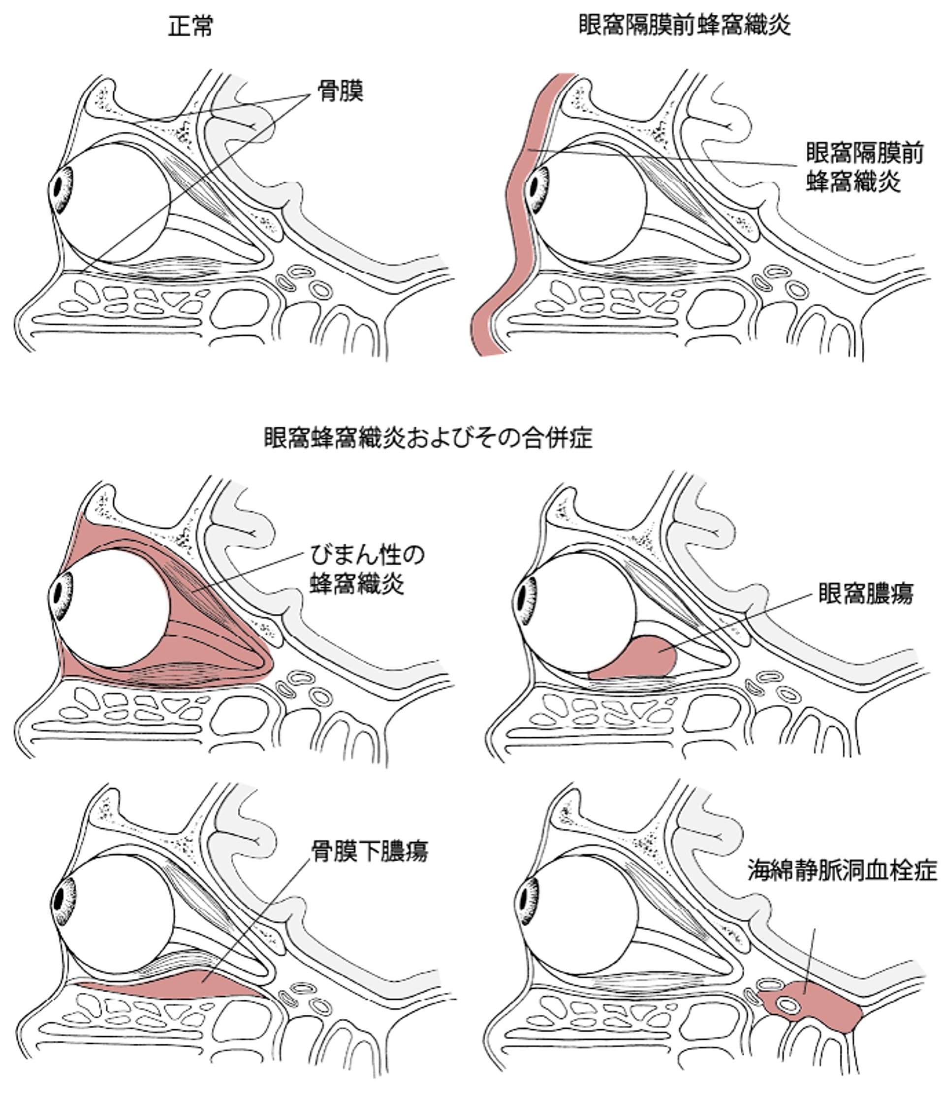 眼窩隔膜前蜂窩織炎および眼窩蜂窩織炎