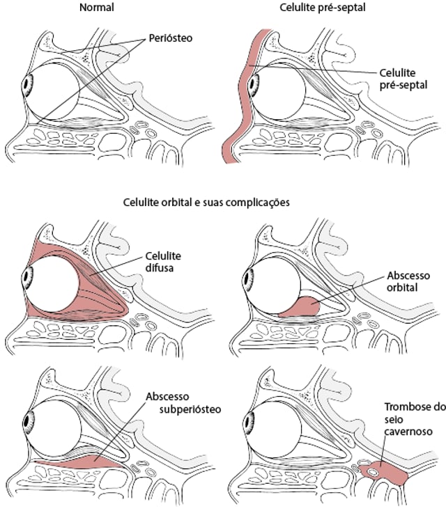 Celulites orbital e pré-septal - Distúrbios oftalmológicos - Manuais ...