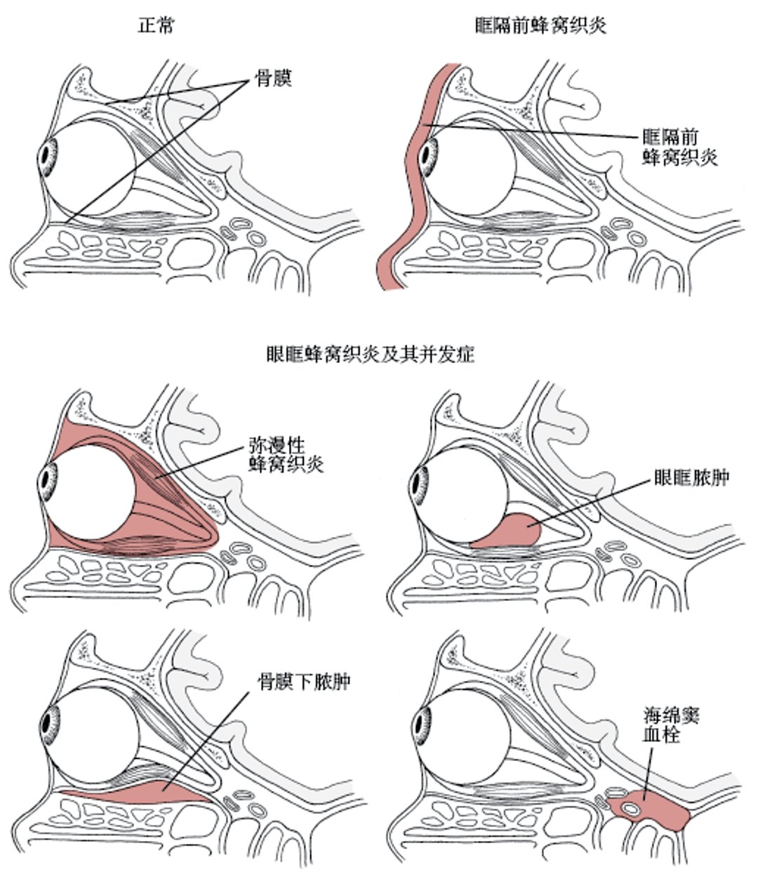眶隔前和眼眶蜂窝织炎