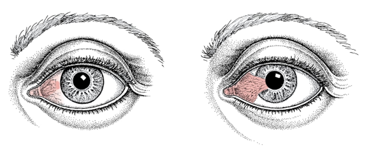 Pinguecula and Pterygium