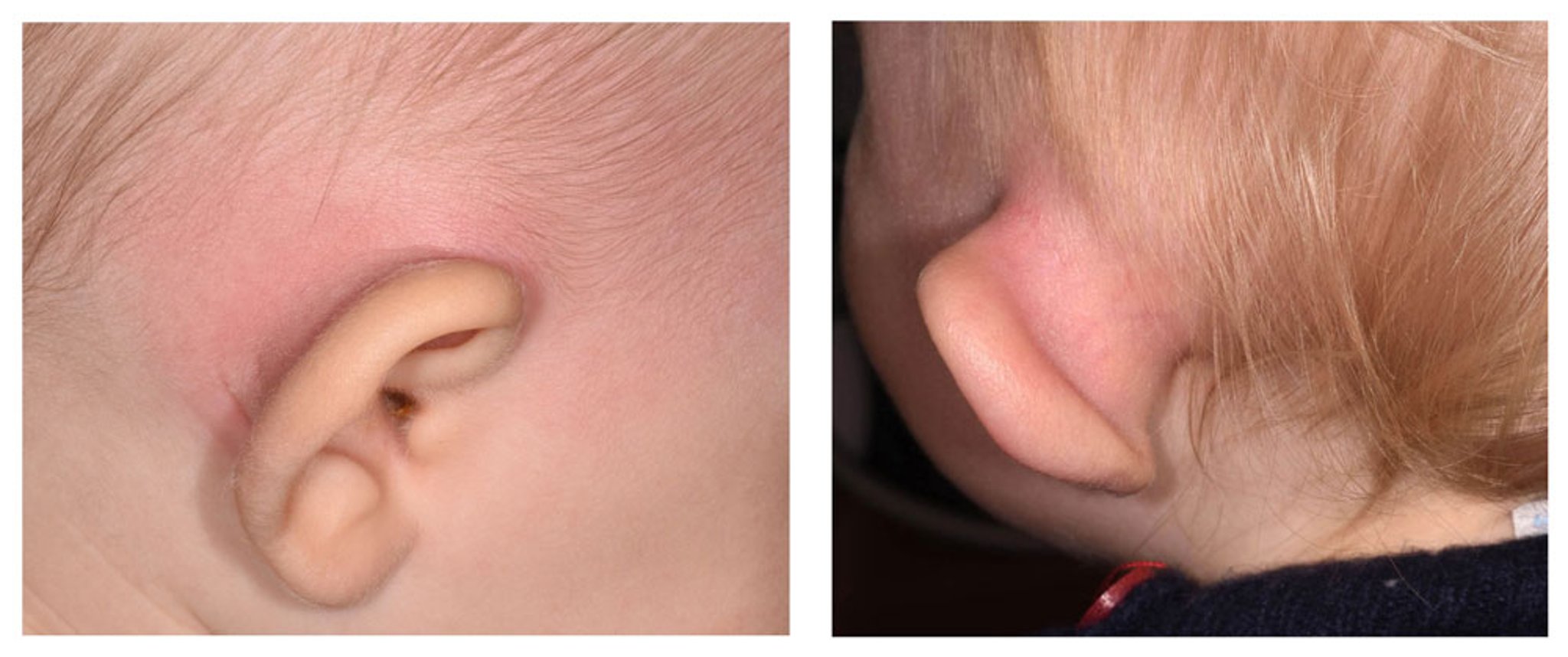 急性乳突炎导致的耳廓变形