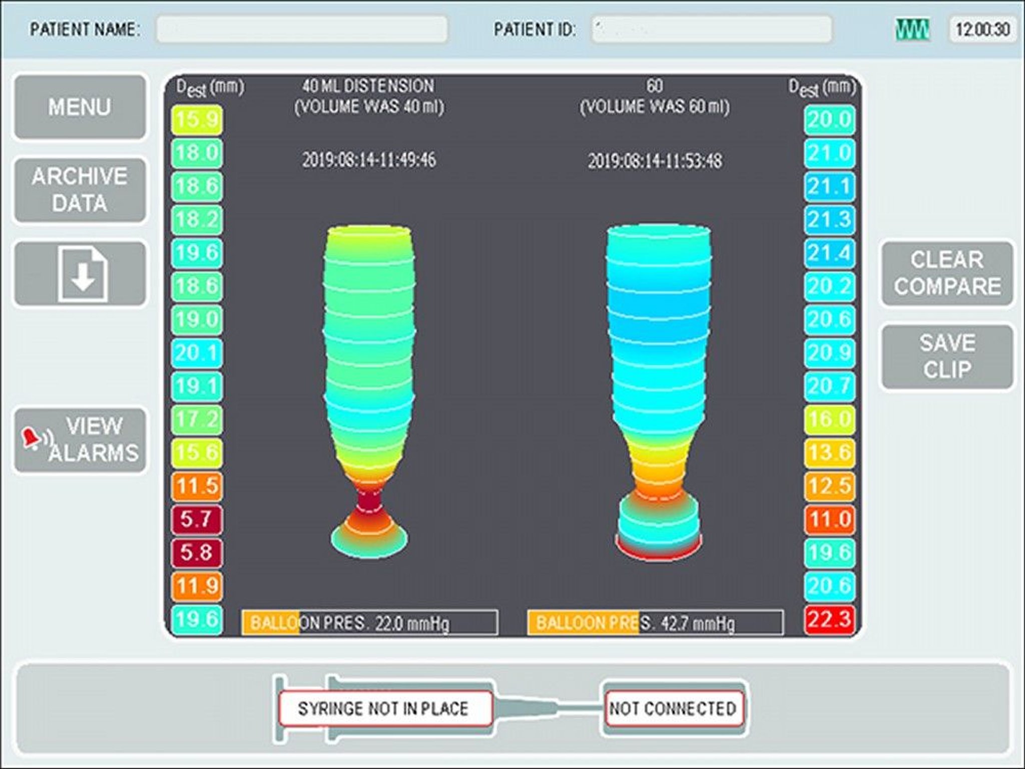 Impedance planimetry