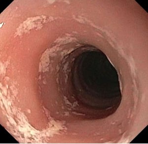 Exsudate bei eosinophiler Ösophagitis