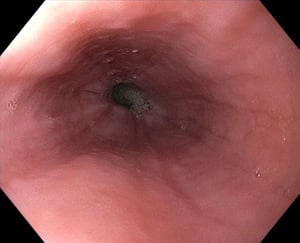 Furchen bei eosinophiler Ösophagitis