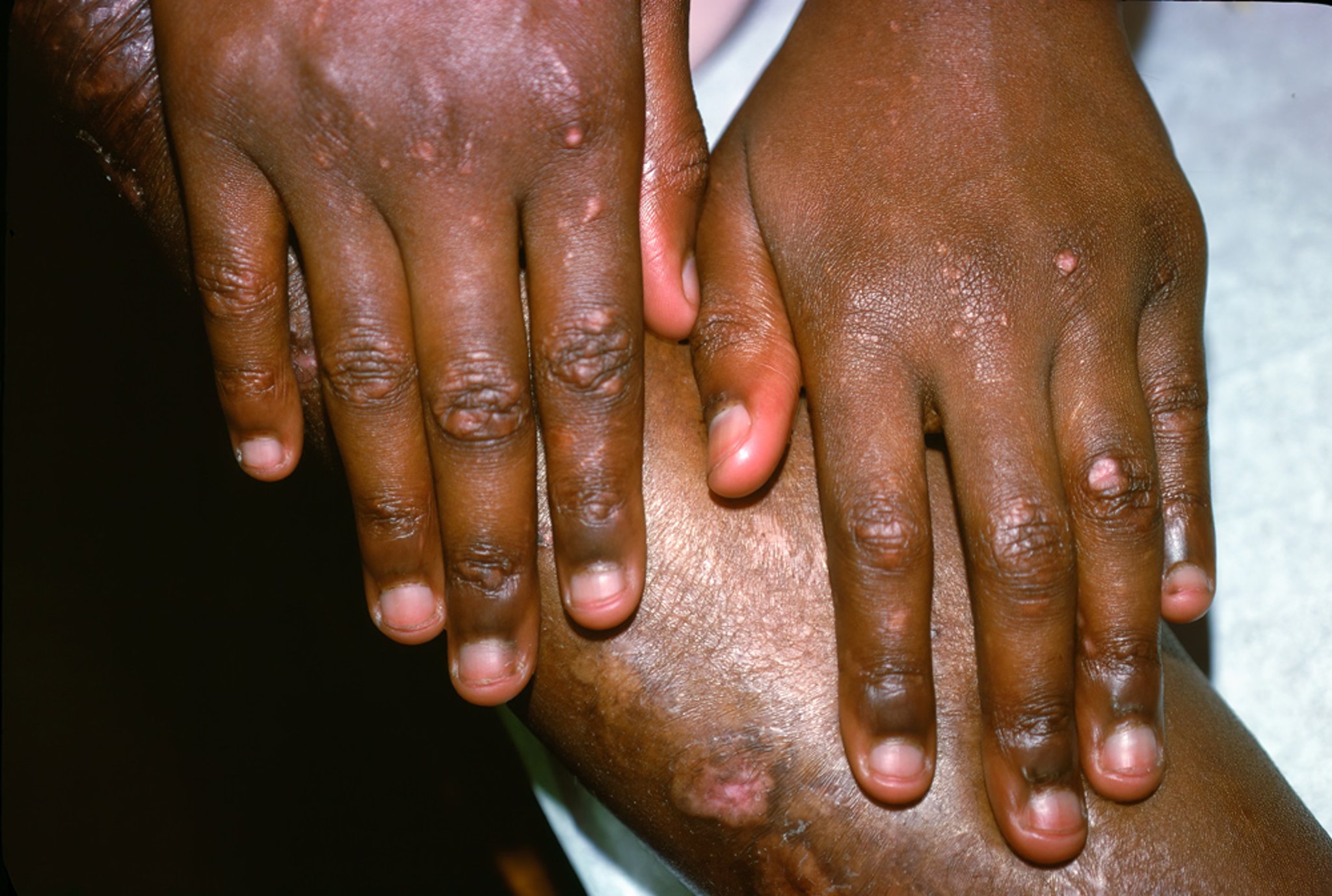 Dystrophic Epidermolysis Bullosa