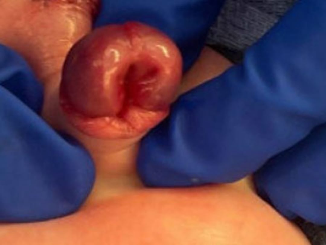 Епіспадії (дорсальні)