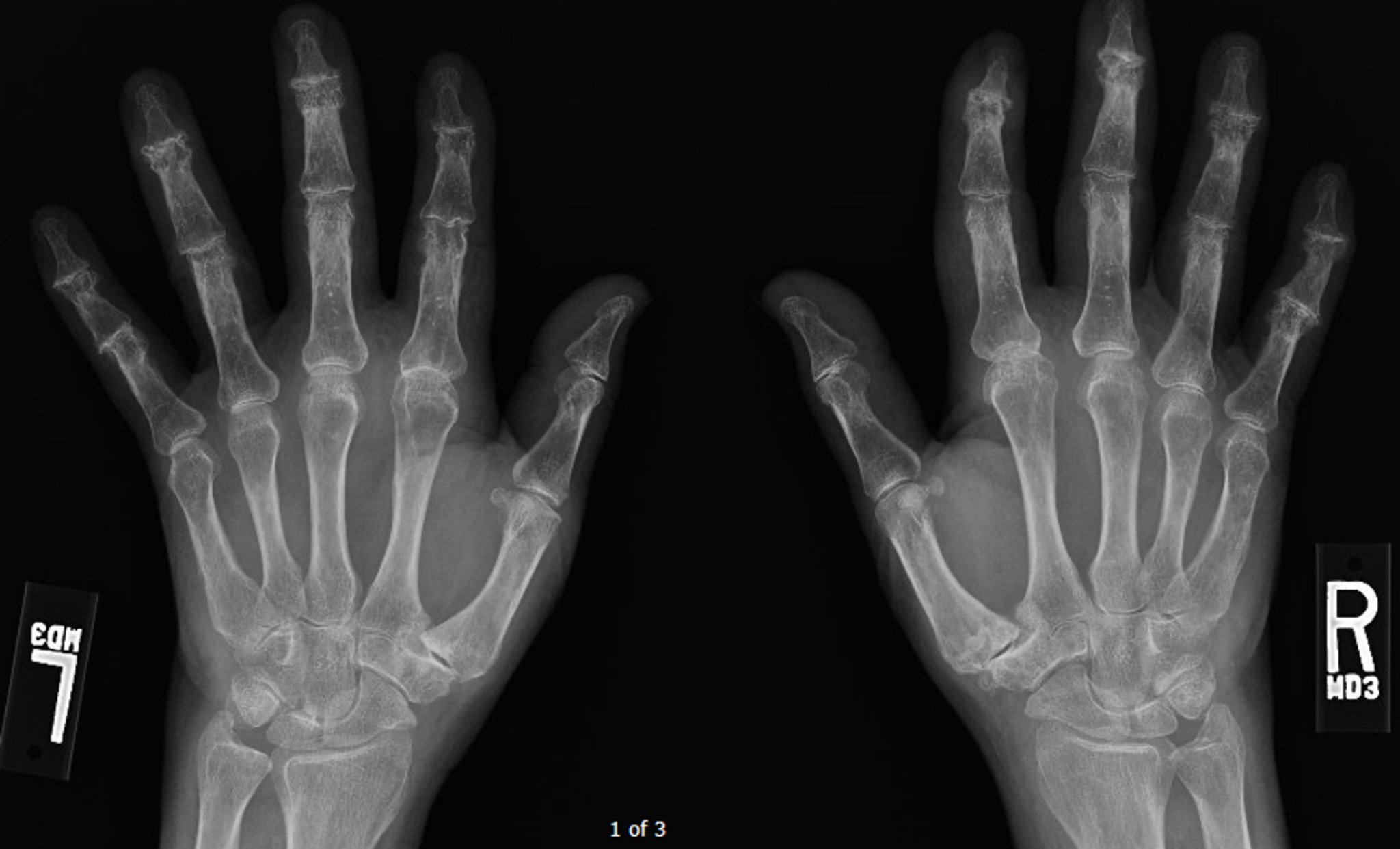 Osteoartrite erosiva