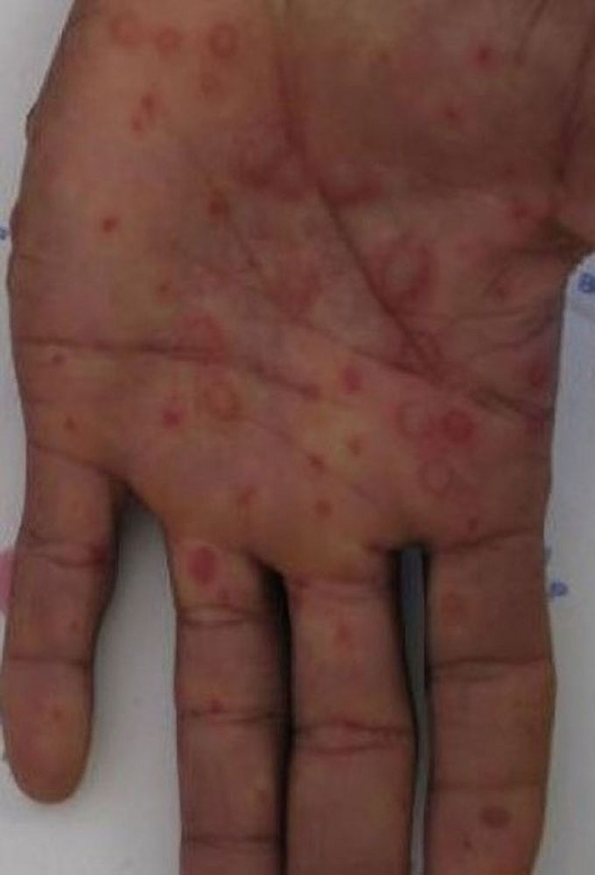 Erythema Multiforme (Palm)