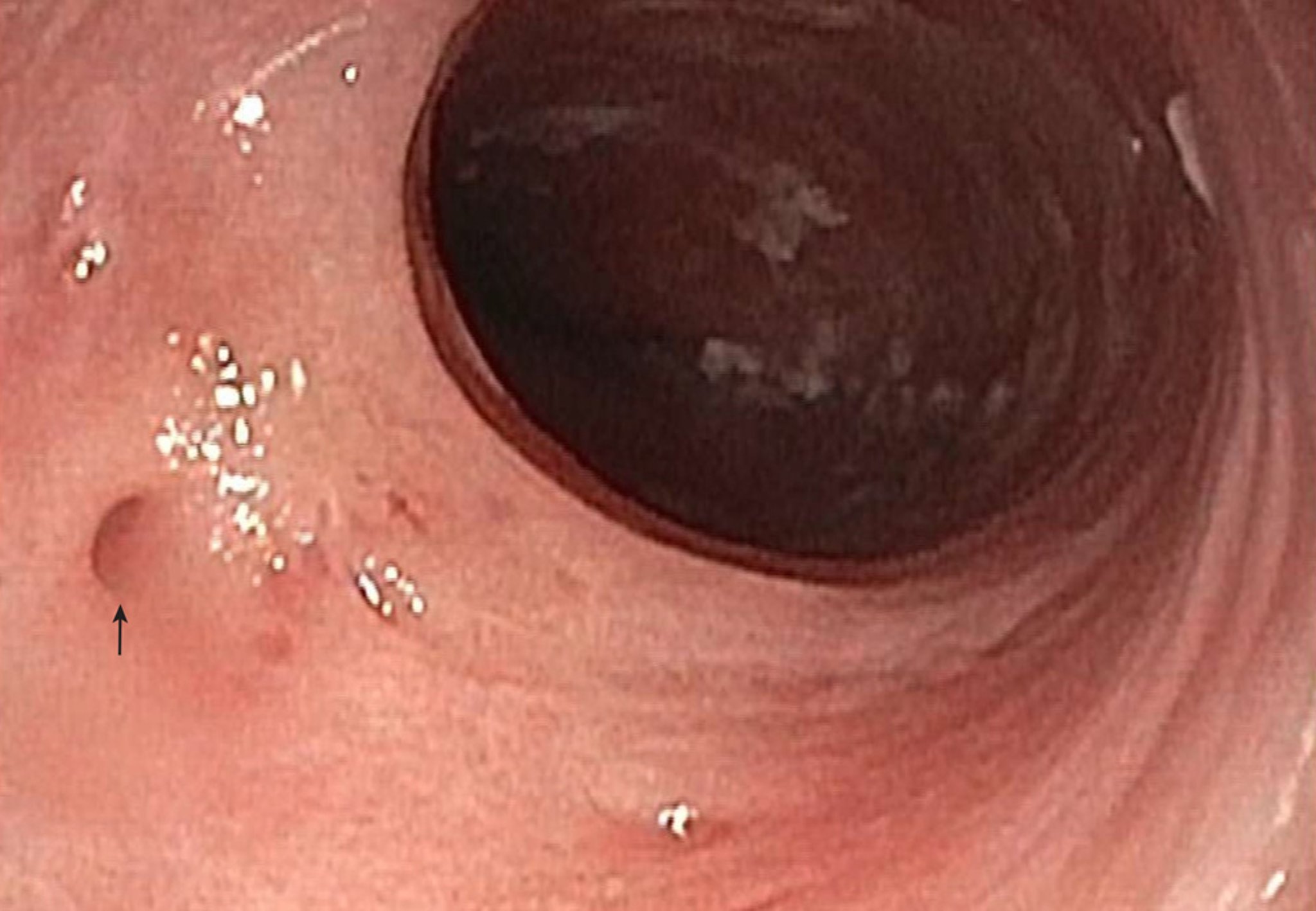 Esophageal Diverticulum