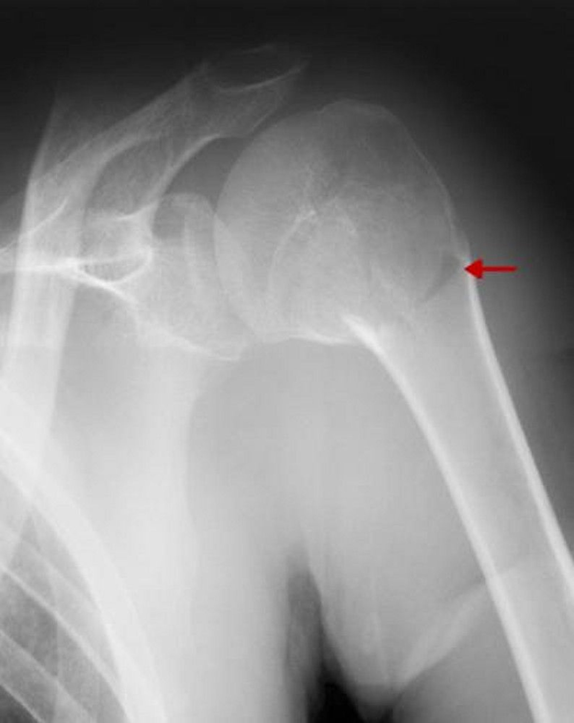 Proximal Humerus Fracture