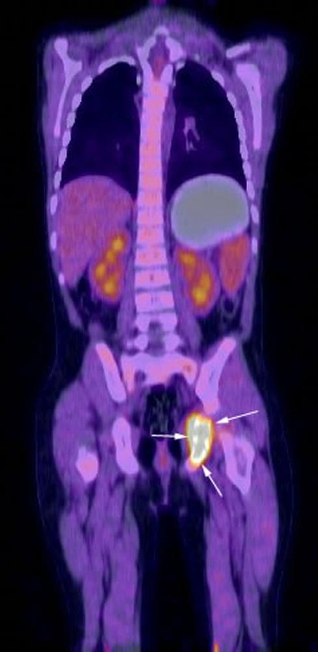 FDG-PET-CT