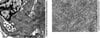 Fibrillary Glomerulopathy (Fibrils)