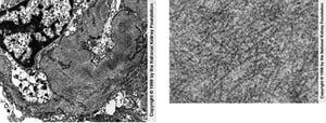 Glomérulopathie fibrillaire (fibrilles)