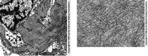 Glomerulopatia fibrilar (fibrilas)