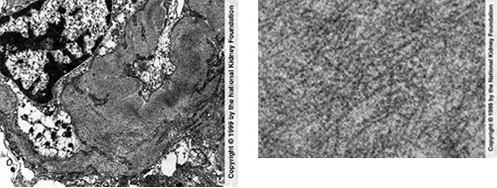 纤维丝样肾小球病(Fibrils)