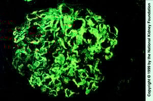 Glomerulopatia fibrillare (deposito di IgG)