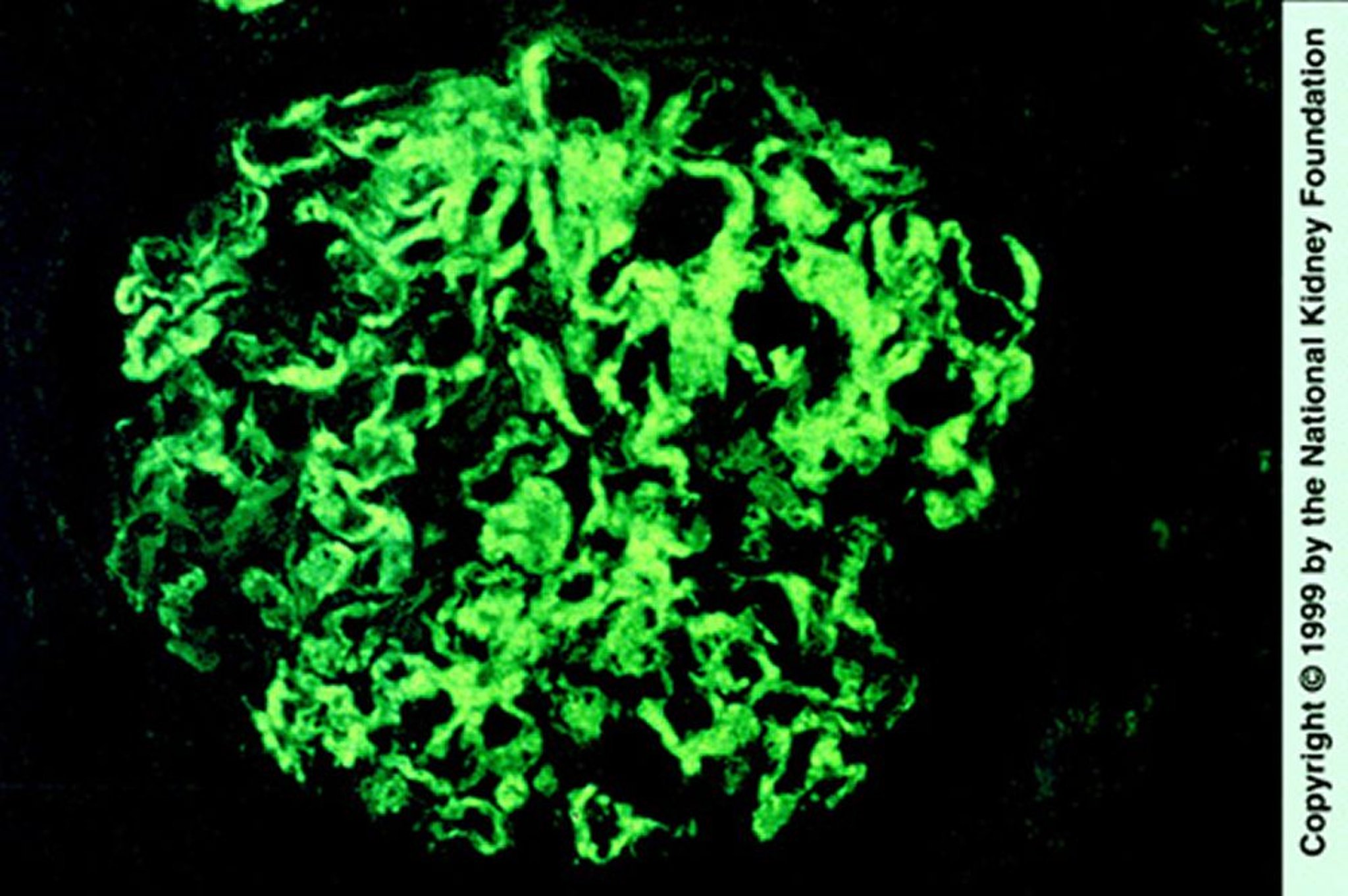Glomerulopatia fibrilar (deposição de IgG)