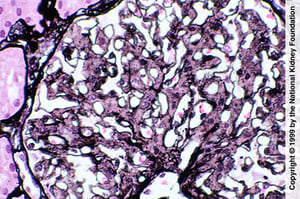 Glomerulopatía fibrilar (proliferación mesangial)
