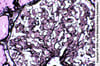 Glomérulopathie fibrillaire (prolifération mésangiale)