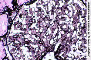Glomérulopathie fibrillaire (prolifération mésangiale)