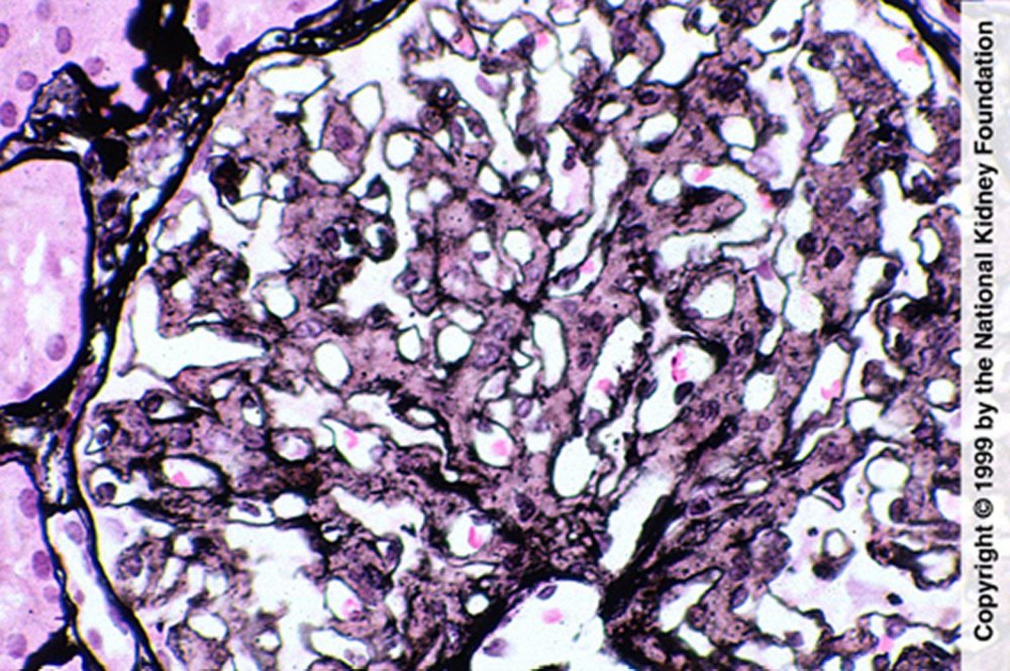 Glomerulopatia fibrillare (proliferazione mesangiale)