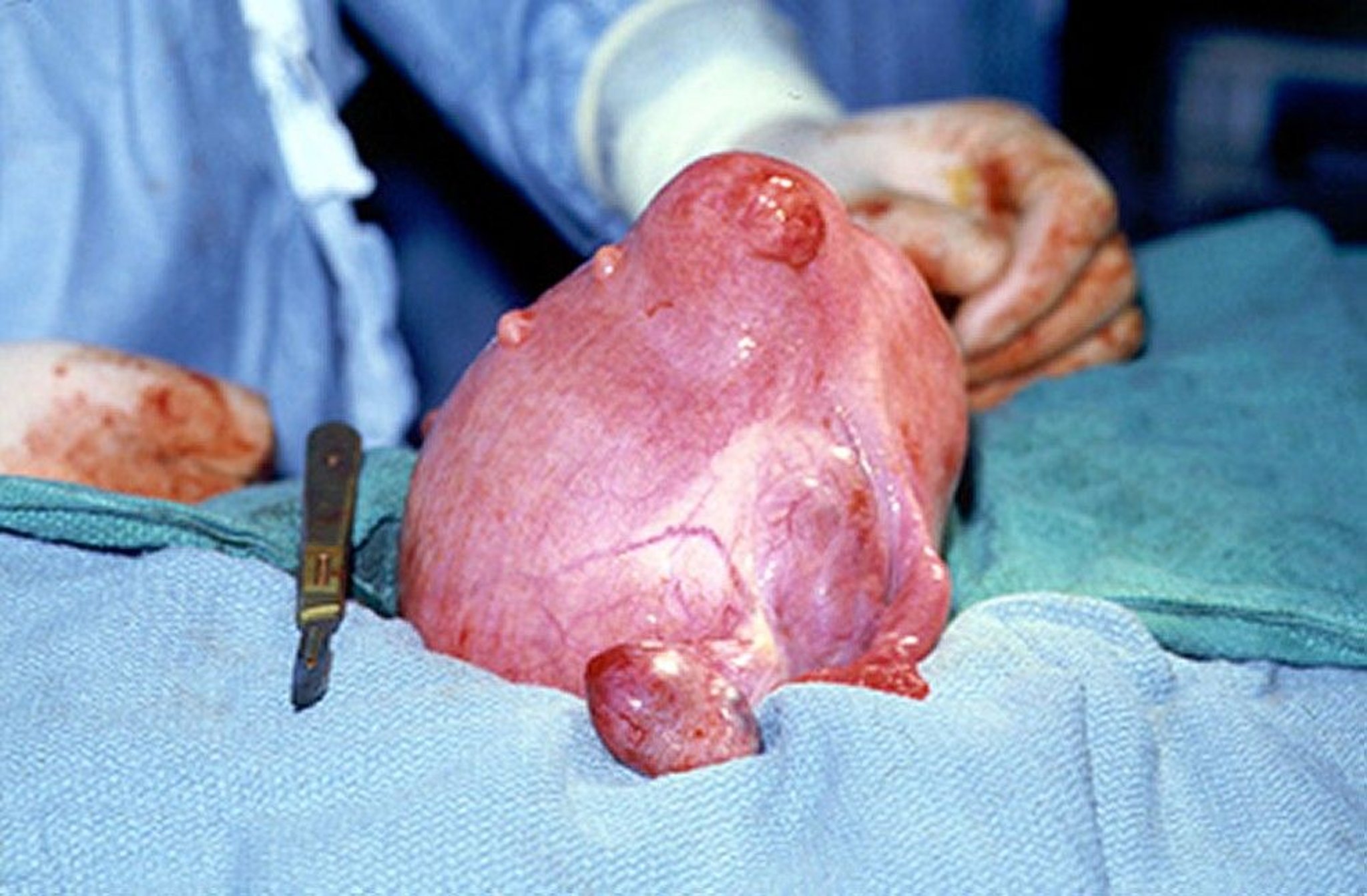 Fibroids