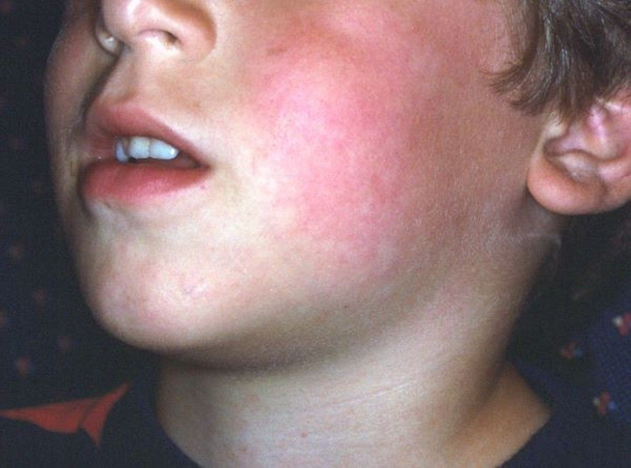 Erythema Infectiosum (Slapped Cheek)