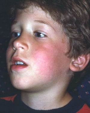 Erythema infectiosum (Ohrfeigen)