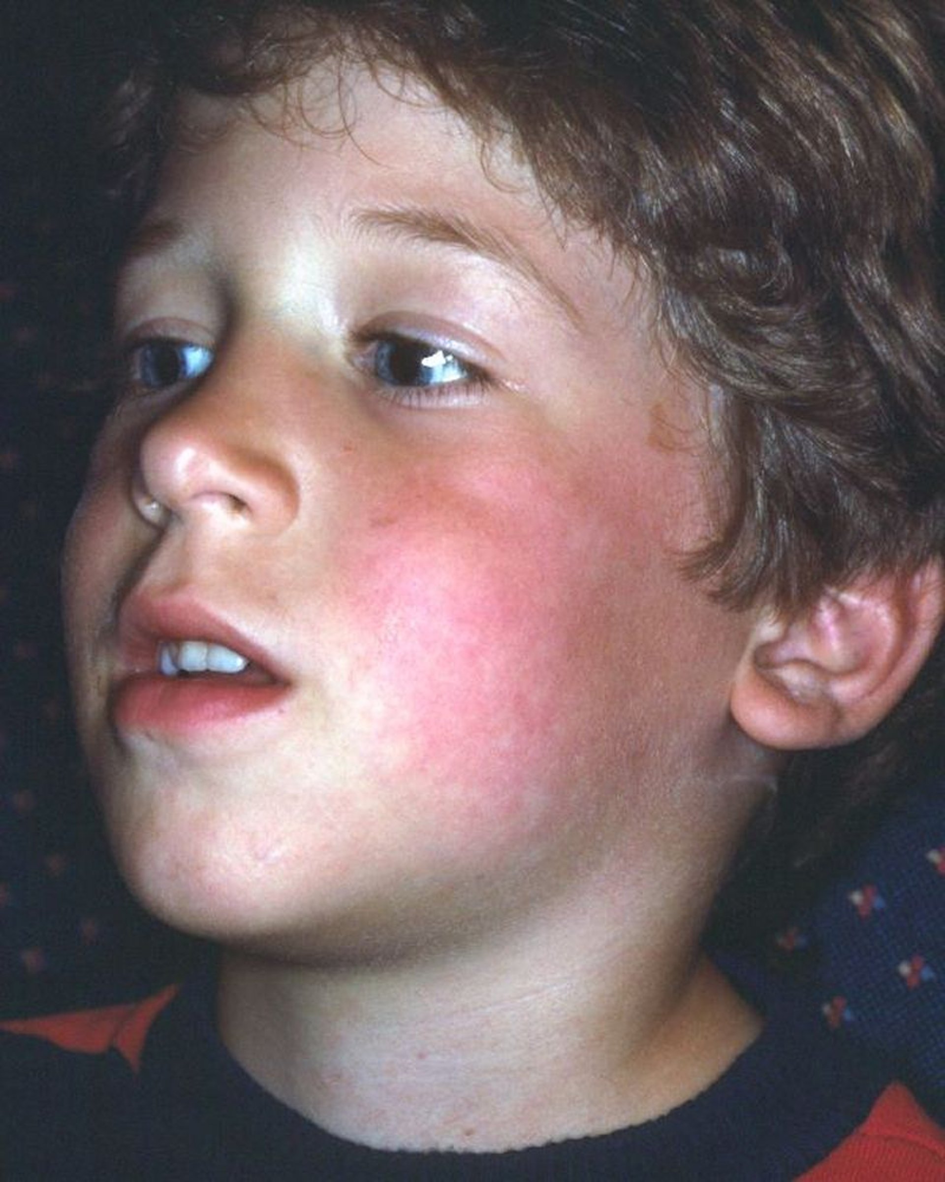 Érythème infectieux (joue giflée)