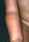Eritema infeccioso (Brazo)