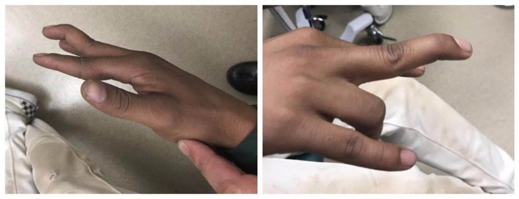 Dislocation of the Proximal Interphalangeal Joint