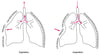 Flail Chest