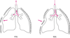 動揺胸郭