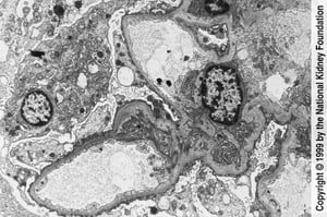 Glomerulosclerosis focal y segmentaria (pedicelos redondeados y efacelados)