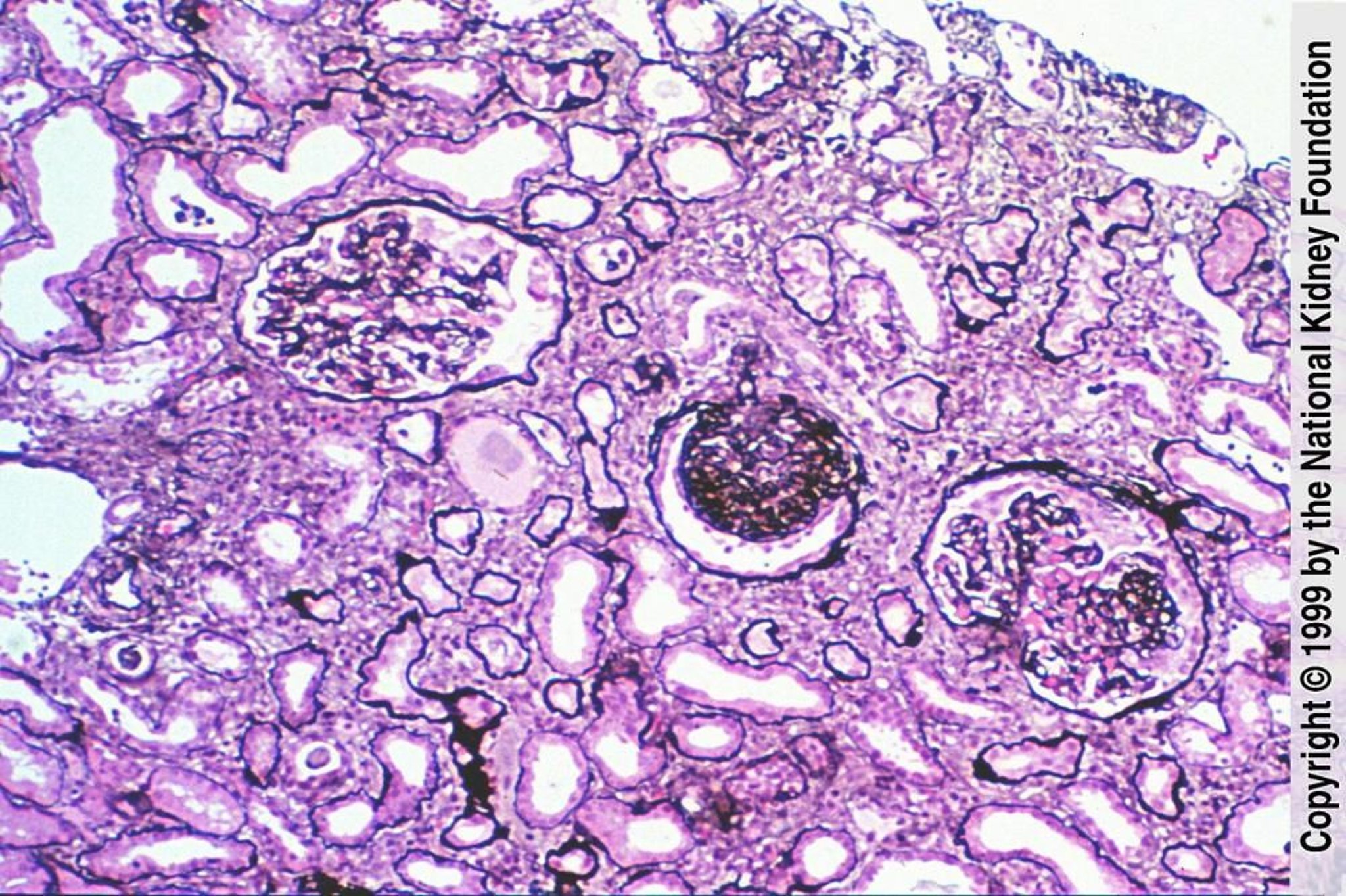 Glomerulosclerosis focal y segmentaria (esclerosis globalizada)