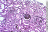 Glomérulosclérose segmentaire et focale (sclérose globale)