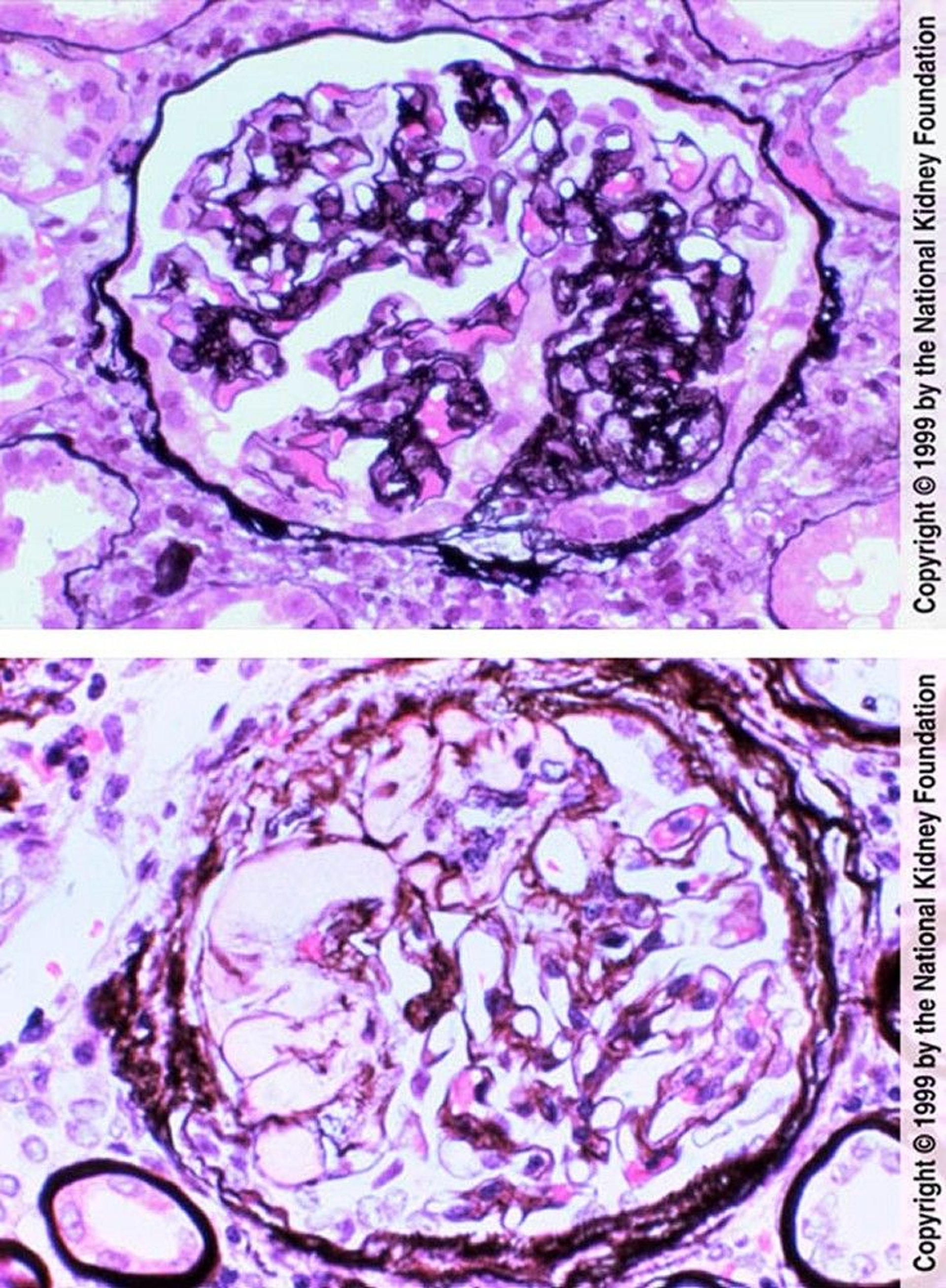 Focal Segmental Glomerulosclerosis