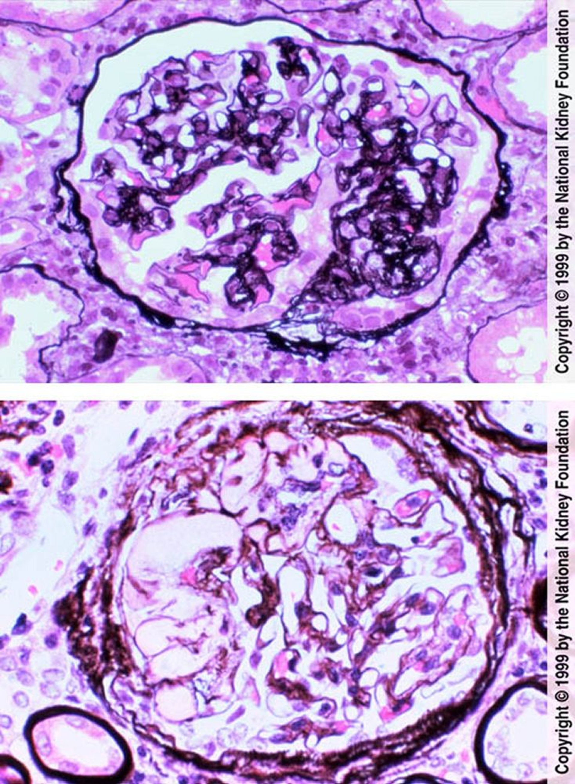 Fokal-segmentale Glomerulosklerose