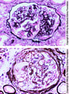 Glomérulosclérose segmentaire et focale