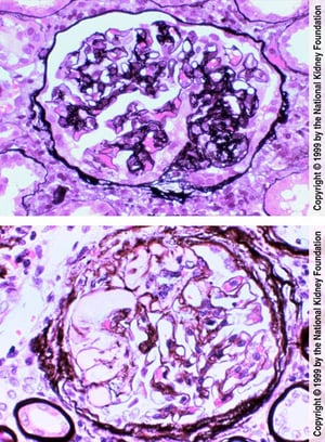 Glomérulosclérose segmentaire et focale