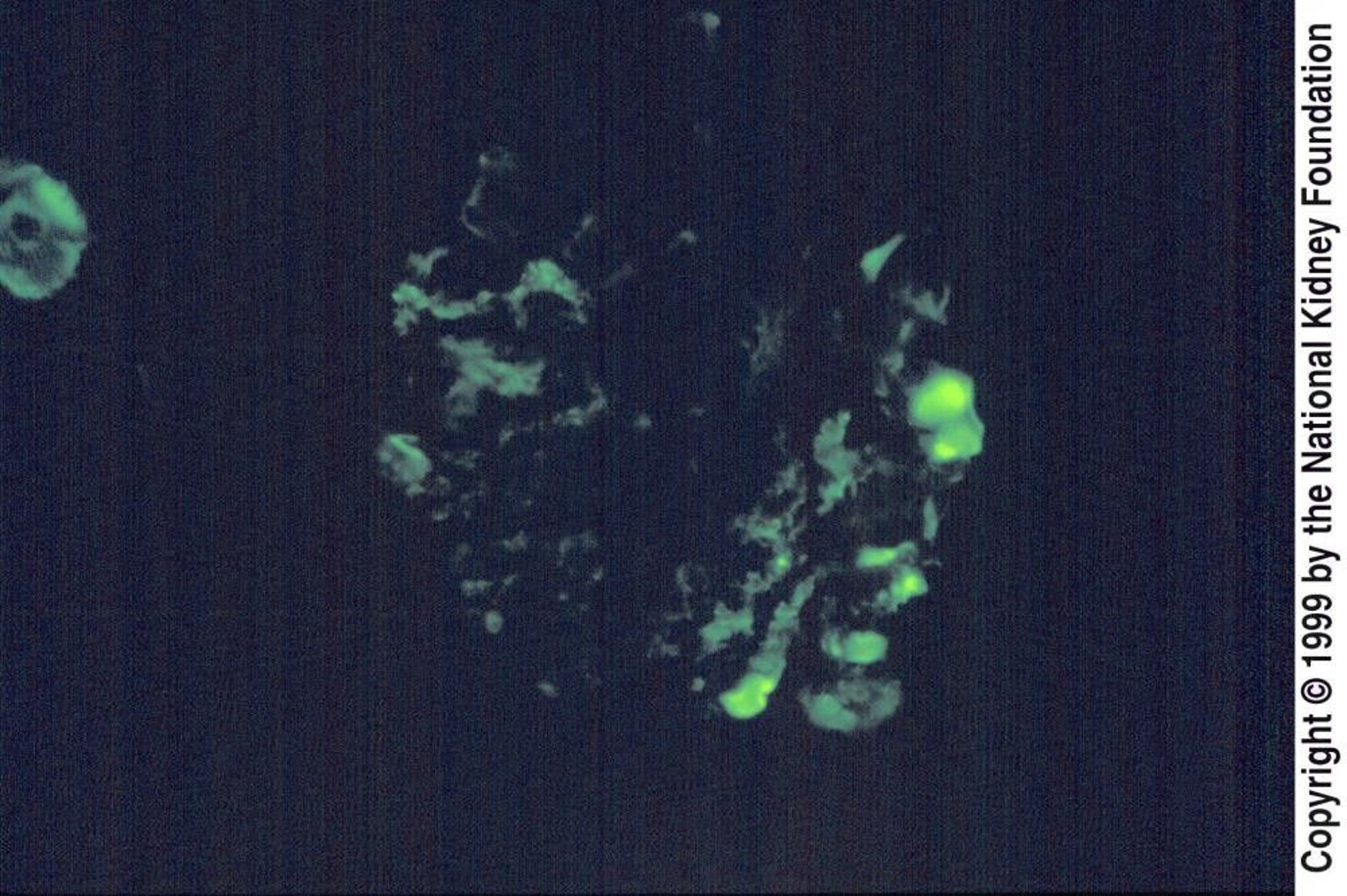 Focal Segmental Glomerulosclerosis (IgM in Mesangium)