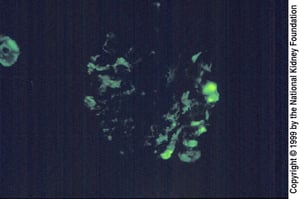 Fokal-segmentale Glomerulosklerose (IgM im Mesangium)