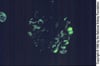 Glomerulosclerosis focal y segmentaria (IgM en mesangio)