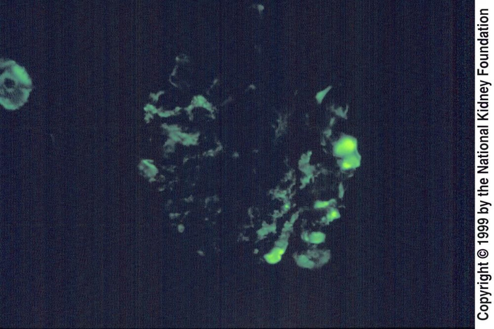 巣状分節性糸球体硬化症（メサンギウム領域のIgM）