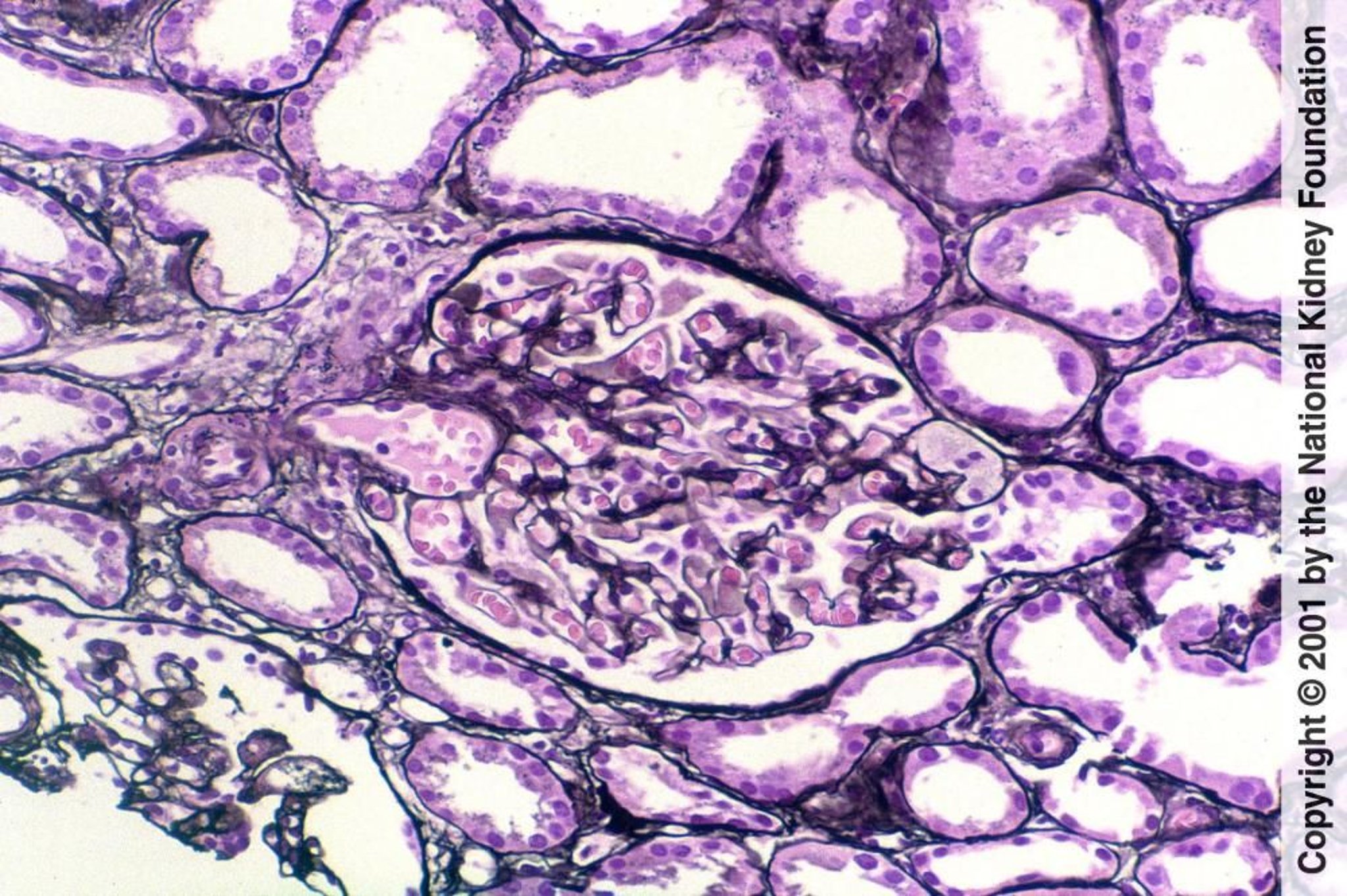 Glomerulosclerosis focal y segmentaria (lesión en la punta)