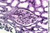 Glomérulosclérose segmentaire et focale