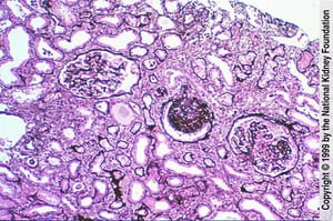 Фокально-сегментарный гломерулосклероз (поражение дистального канальца)