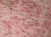 Folliculitis