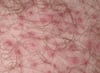 Foliculitis