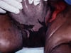Fournier Gangrene